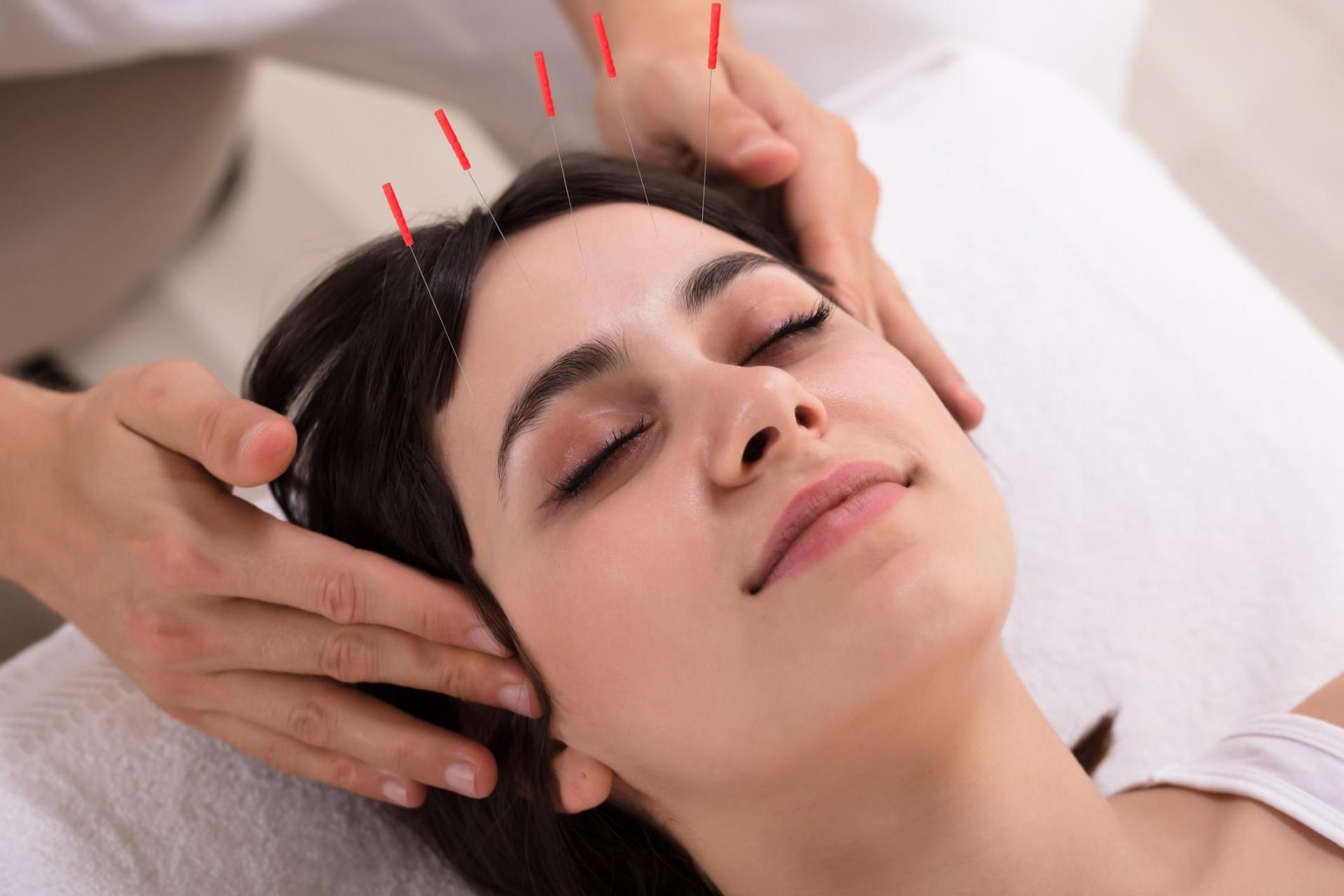 Acupuncture epilepsie