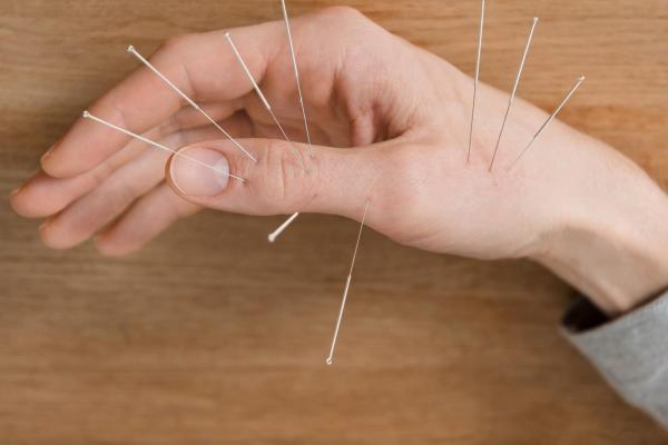 Acupuncture