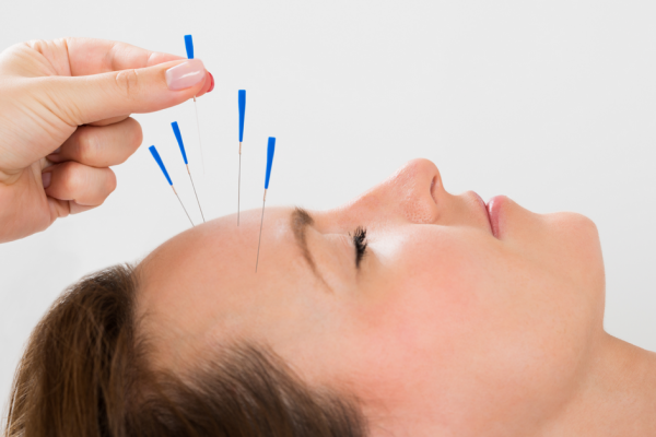 Acupuncture