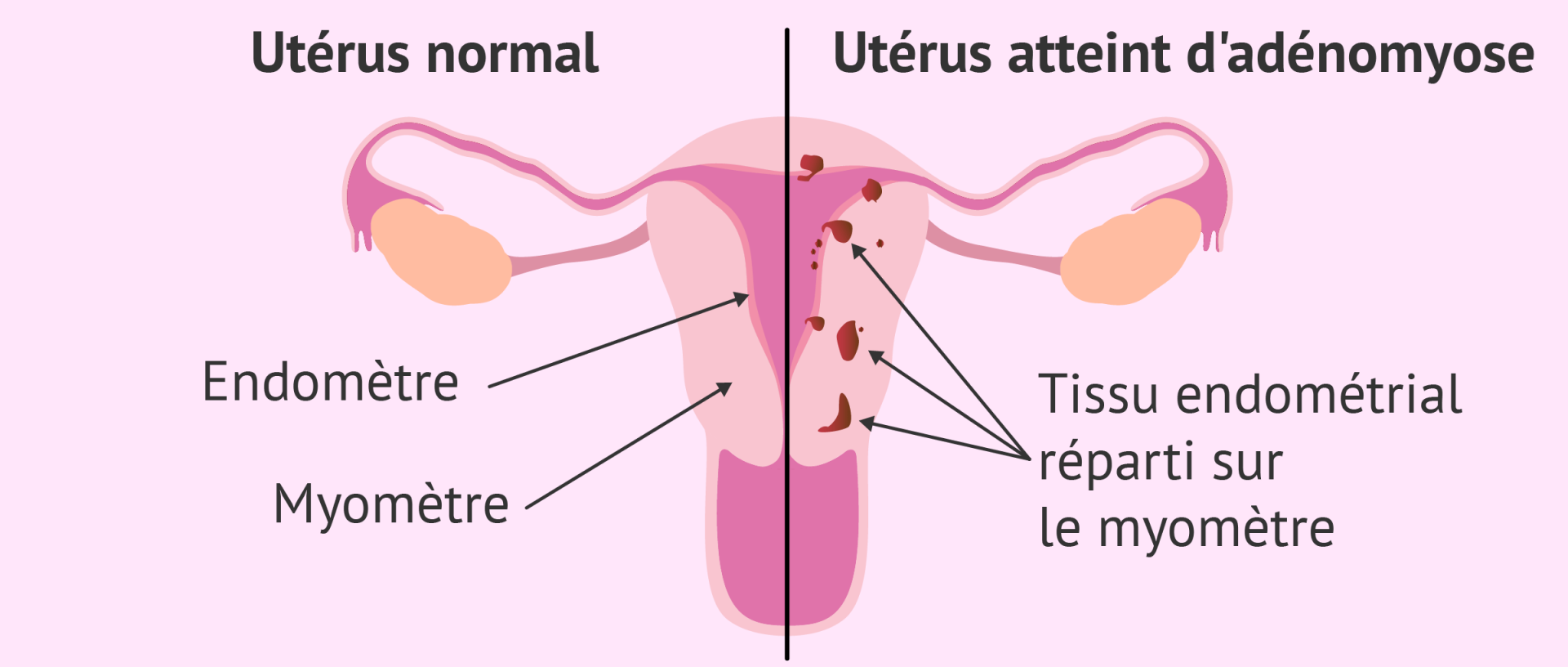 Adenomyose