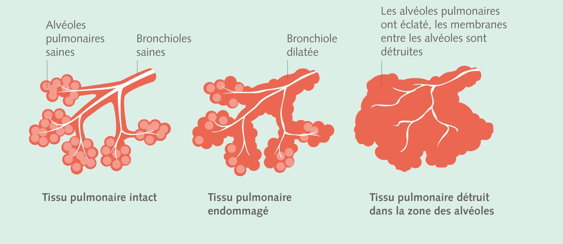 Alveoles endommagees
