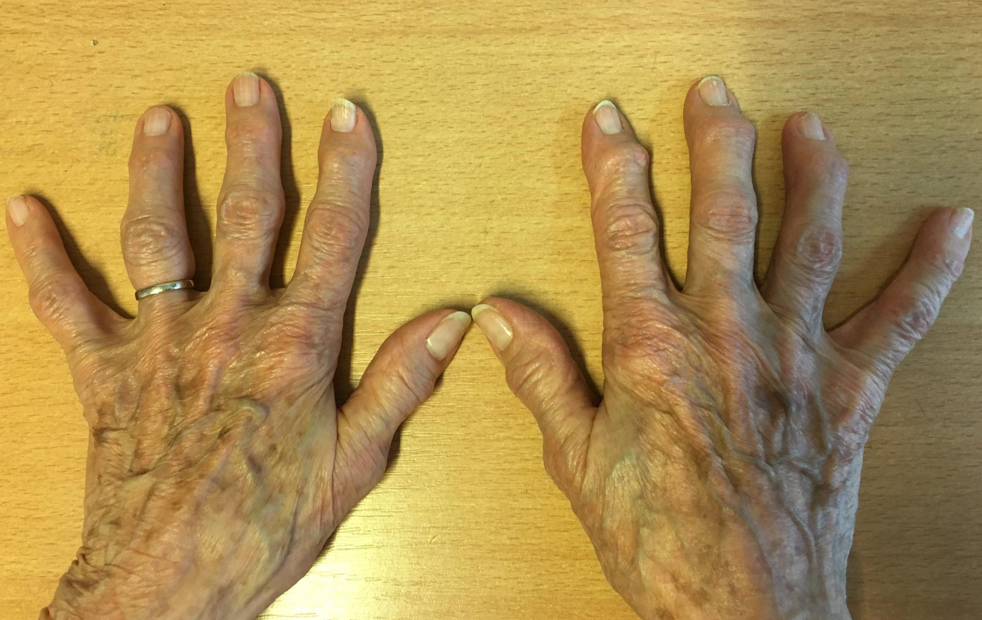 Arthrose des doigts