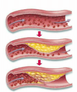 Atherosclerose