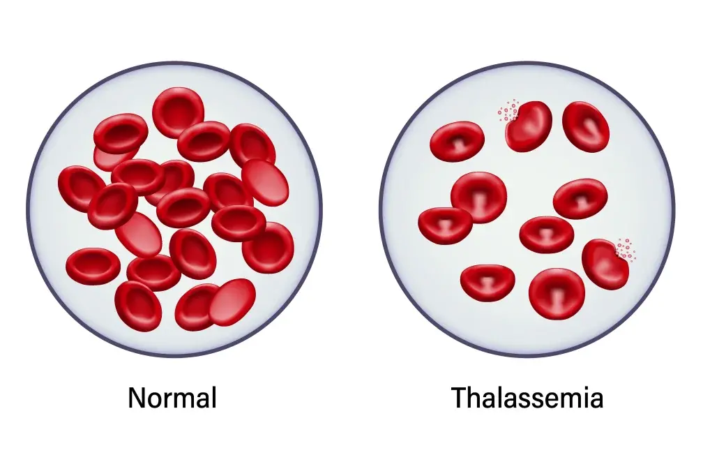 Betathalassemie