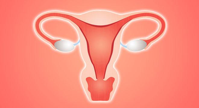 Cancer de l ovaire et kyste ovarien