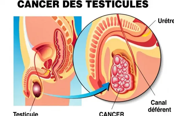 Cancer des testicules