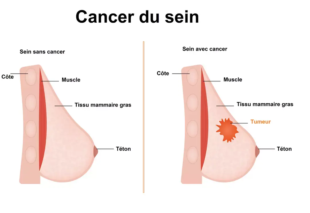 Cancer du sein