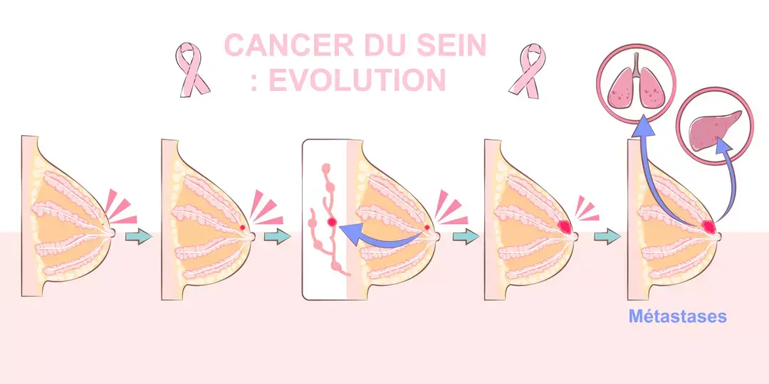 Cancer du sein1