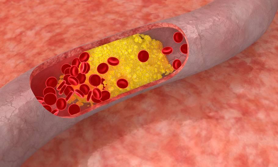 Plantes contre l'excès de cholesterine
