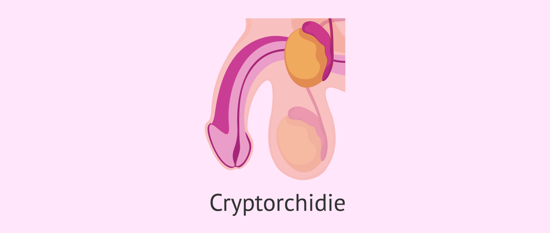 Cryptorchidie testicules ascenseurs