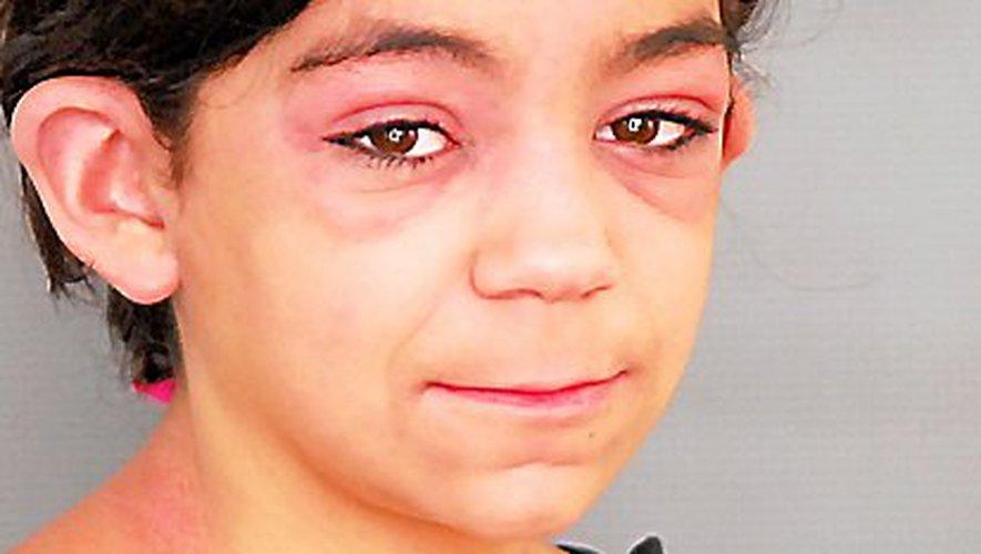 Remedios caseros para las miositis (polimiositis y dermatomiositis)