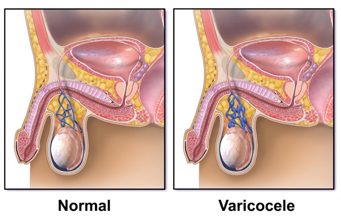 Diagram of a varicocele image