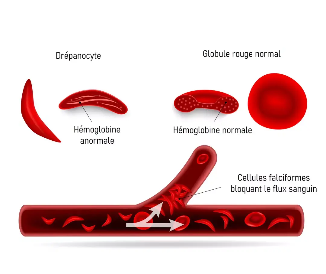 Drepanocytose 1