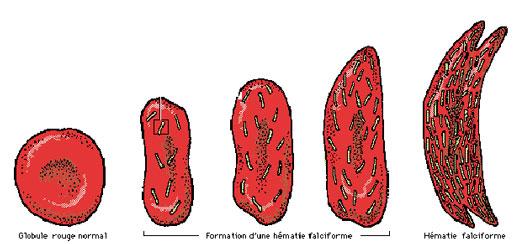 Drepanocytose globules rouges