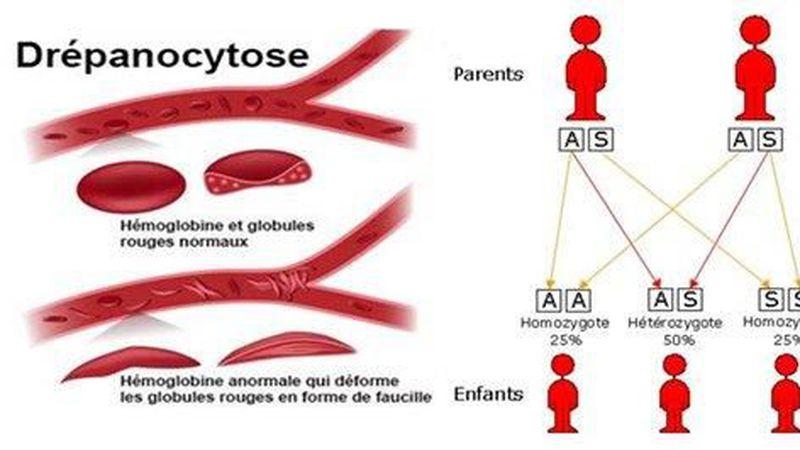 Drepanocytose