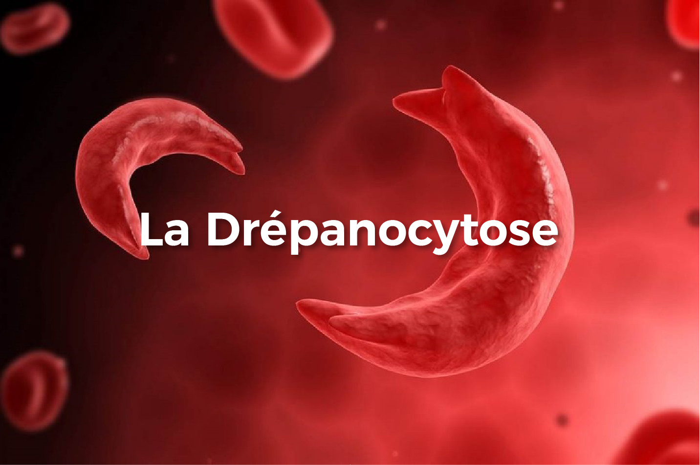 Drepanocytose