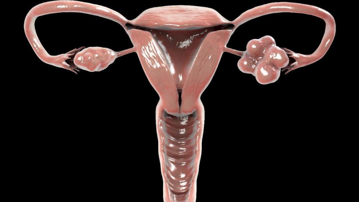 Plantes contre la dystrophie ovarienne