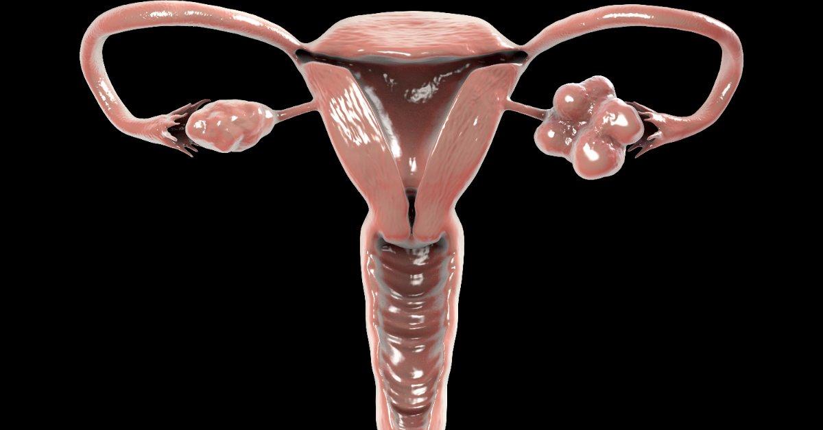 Dystrophie ovarienne sopk uterus