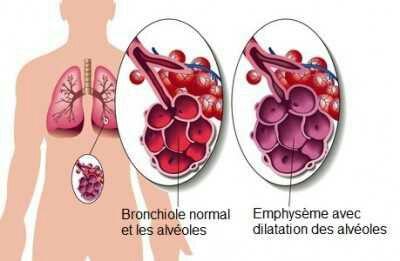 Emphyseme pulmonaire 2