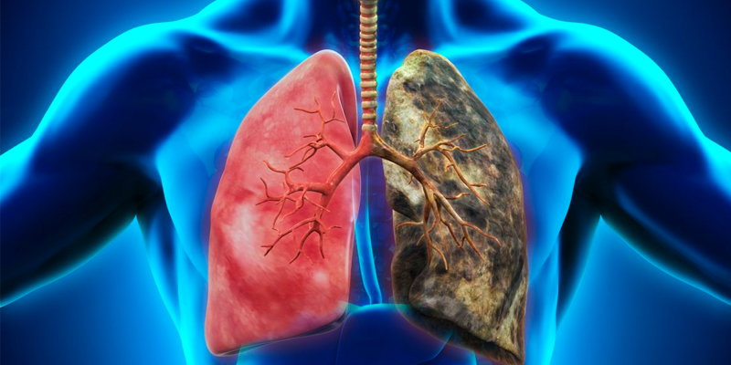 Emphyseme pulmonaire