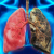 Remèdes naturels et Conseils pour guérir l'emphysème pulmonaire