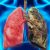 Emphyseme pulmonaire