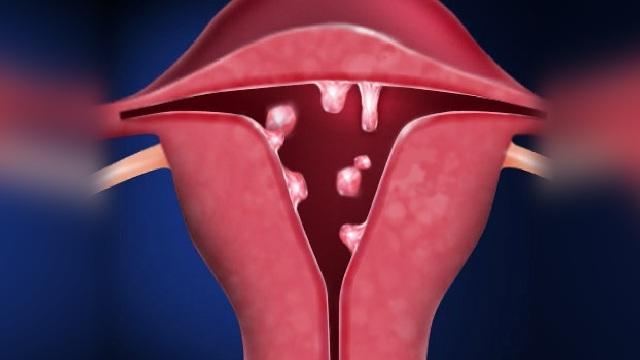 remedios naturales para eliminar polipos uterinos