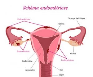 Endometriose 1