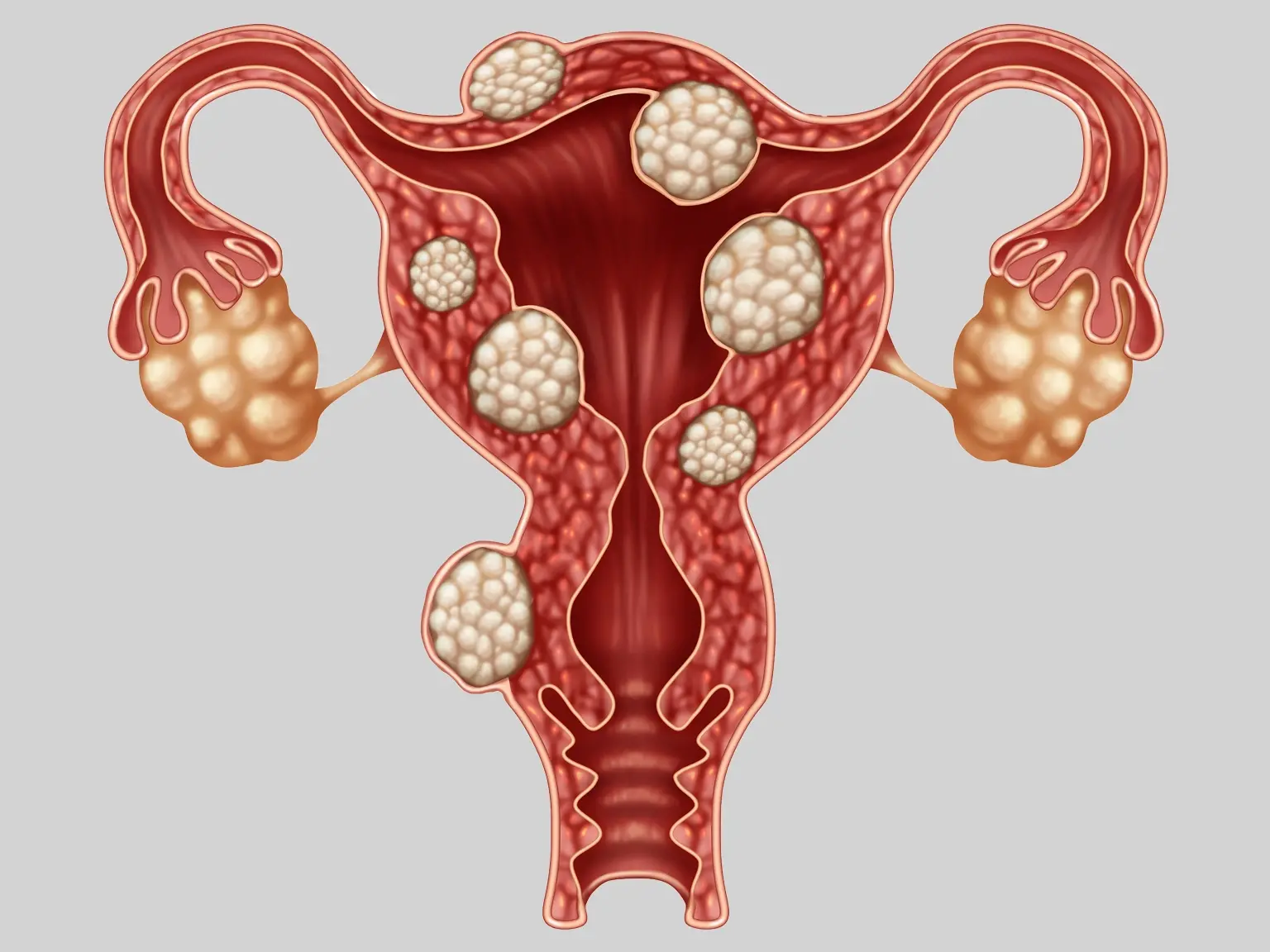 Endometriose 1