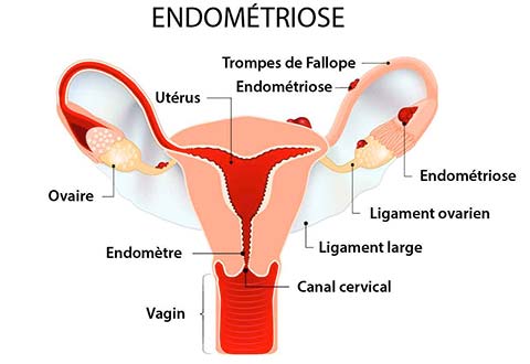 Endometriose 2
