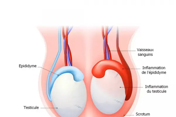 Epididymite