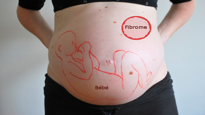 Fibrome uterin et grossesse