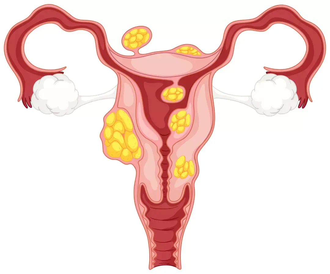 Fibromes uterins