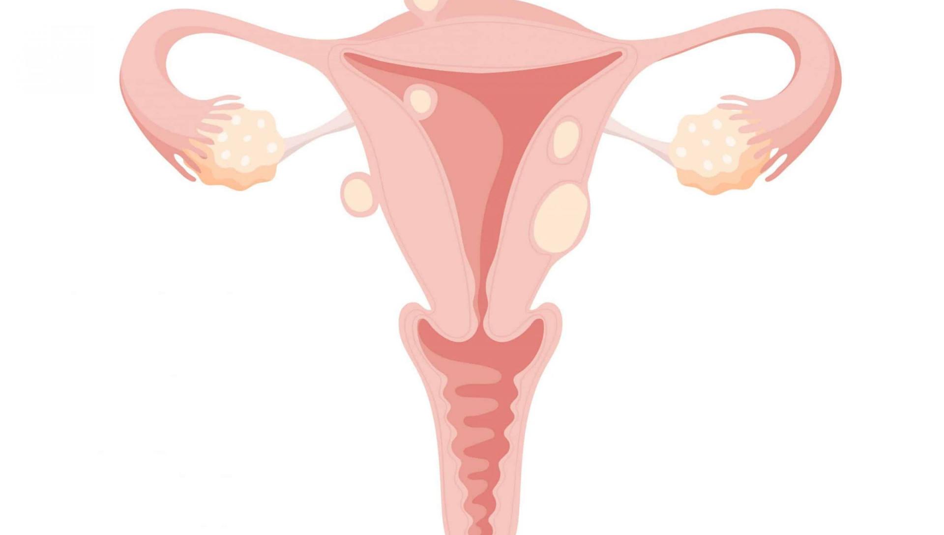 Fibromes uterins1