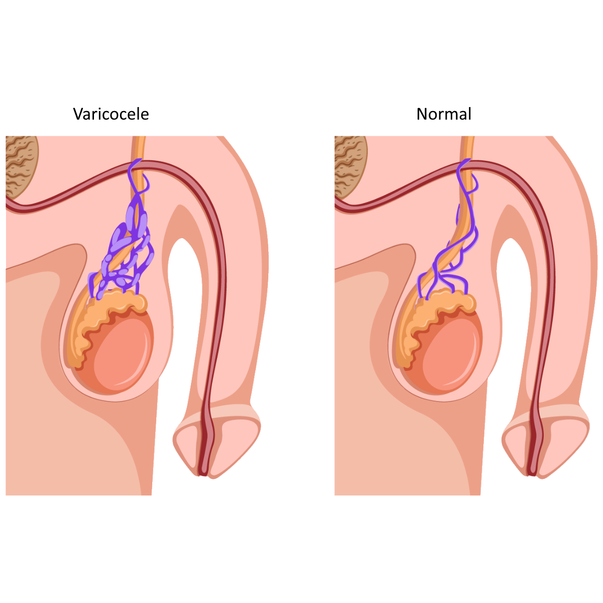 Graphic varicocele