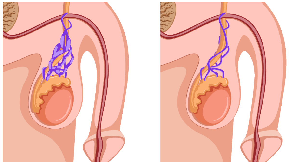 Plants against varicocele