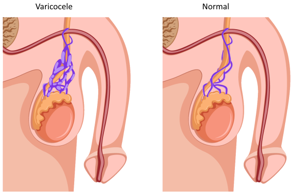 Graphic varicocele