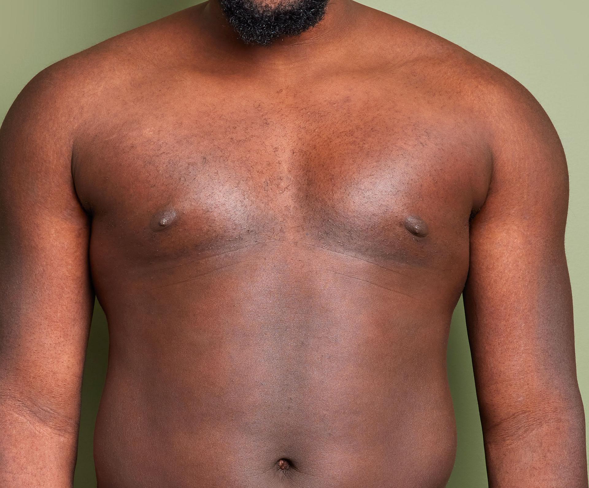 Gynecomastie 