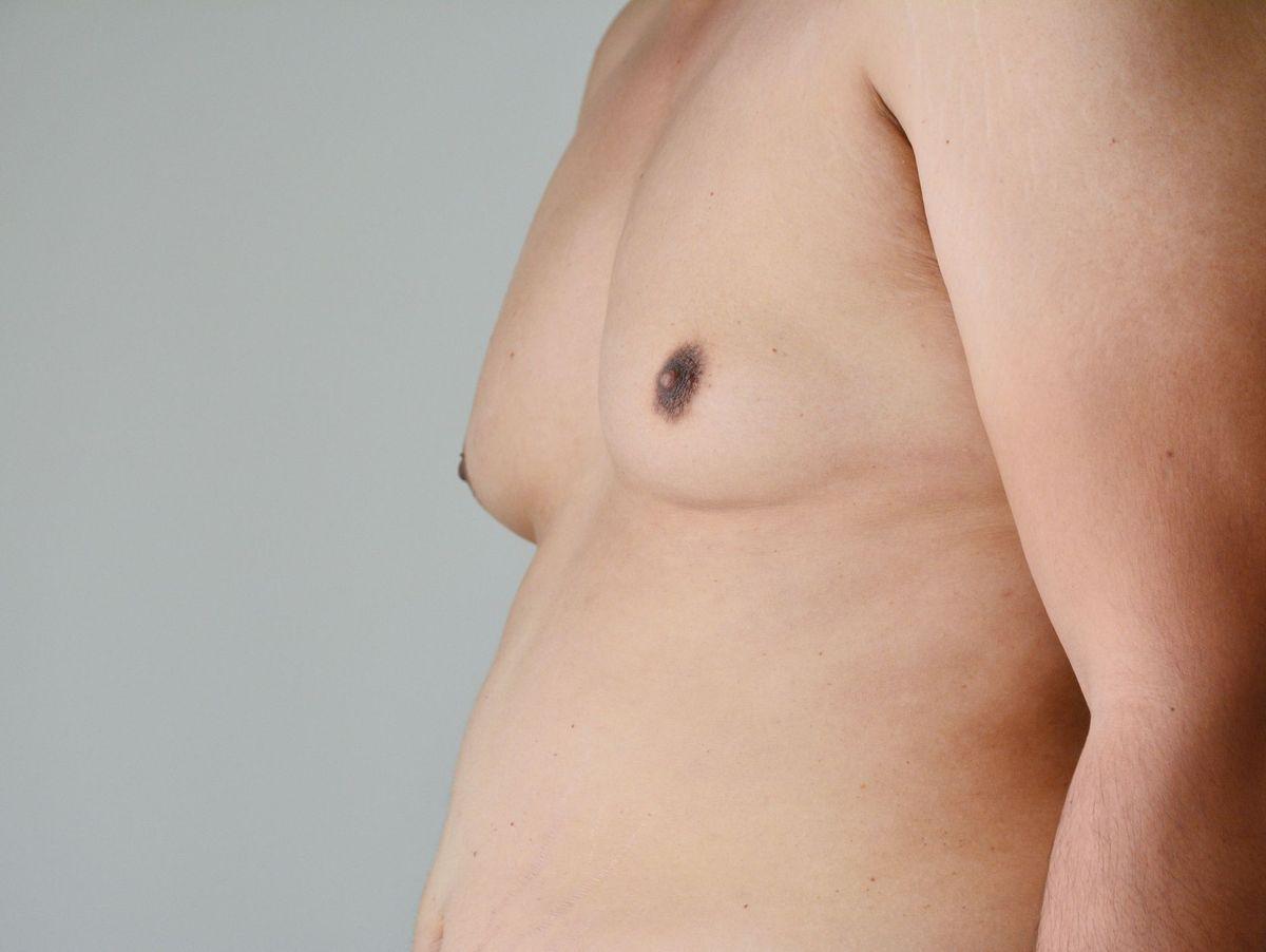 Gynecomastie