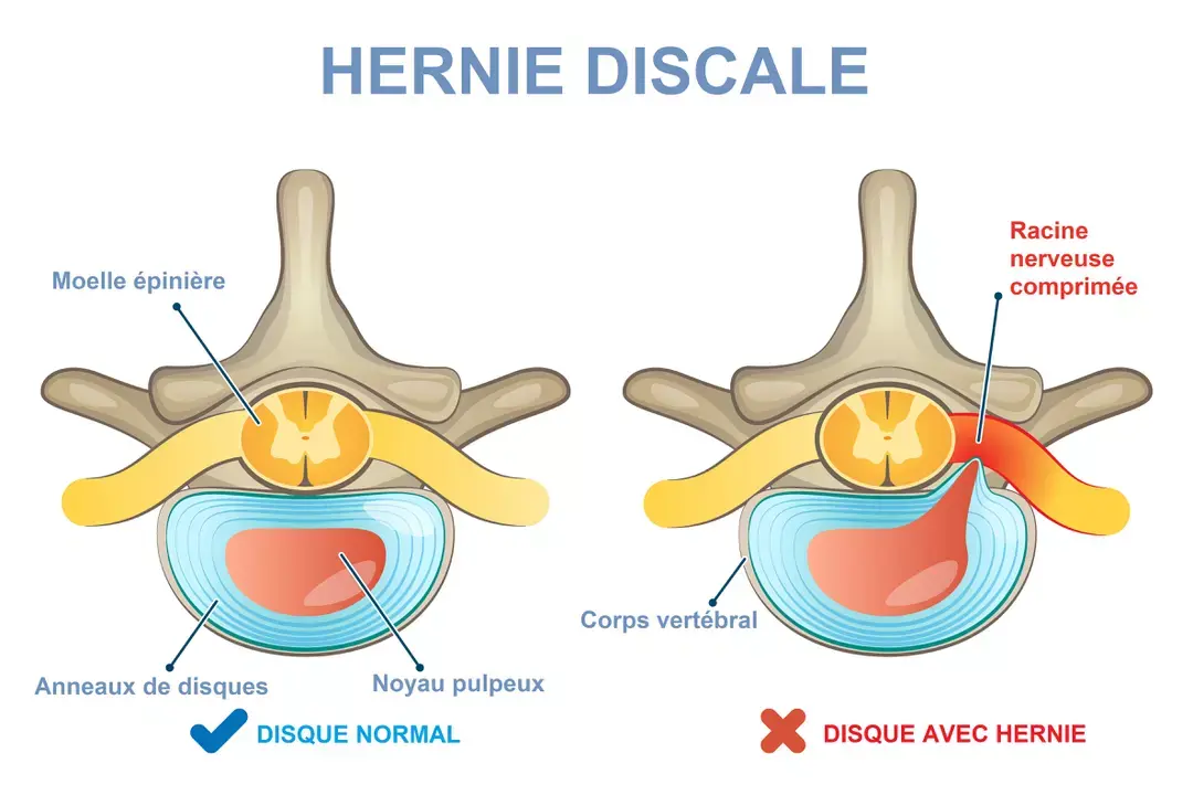 Hernie discale