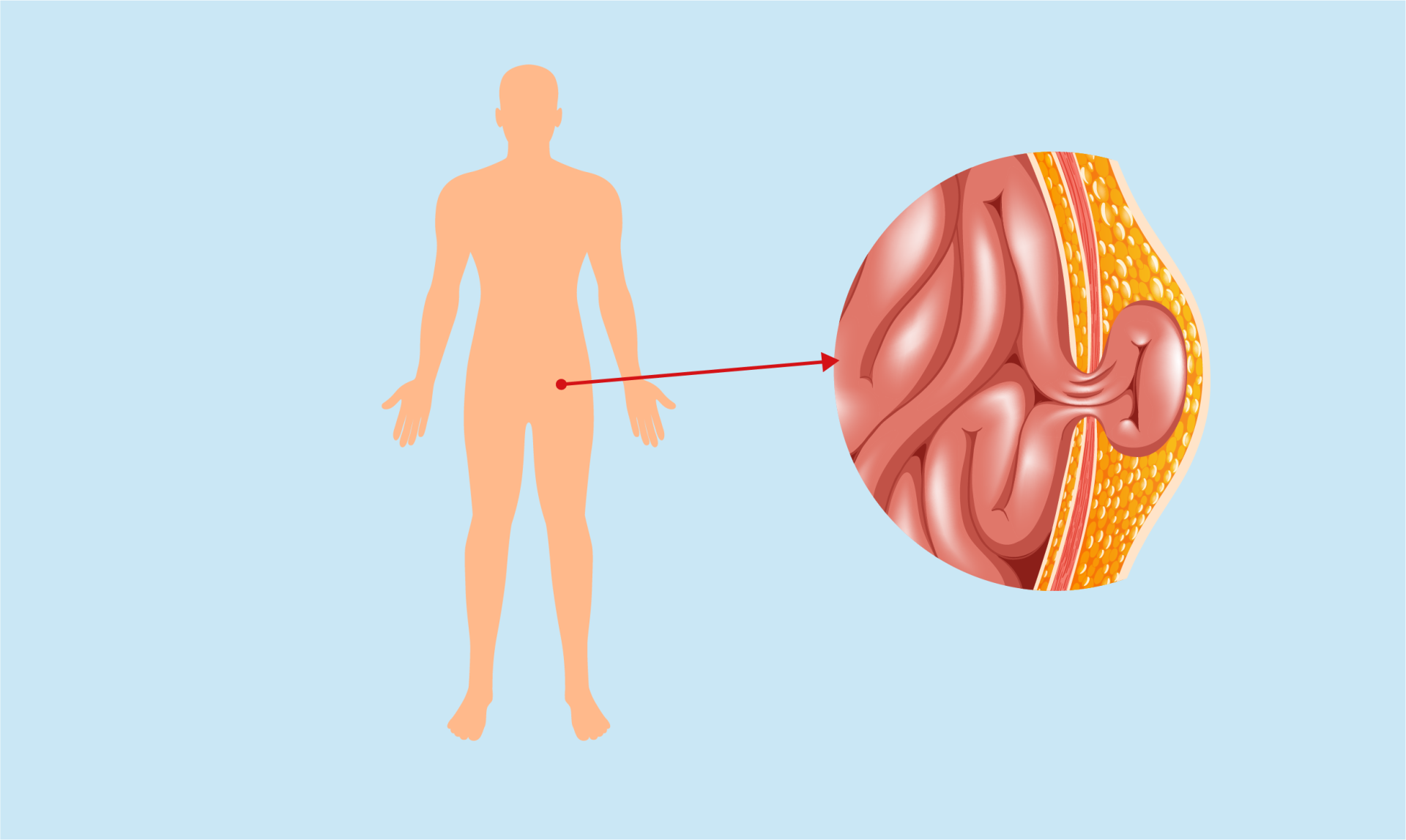 Plantes contre la hernie inguinale