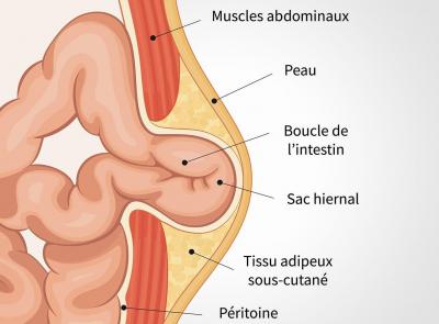 Hernie ombilicale et de la ligne blanche dr stephane servajean a paris