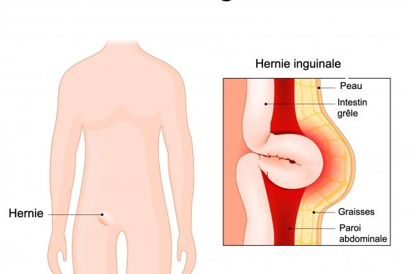 Hernie testiculaire