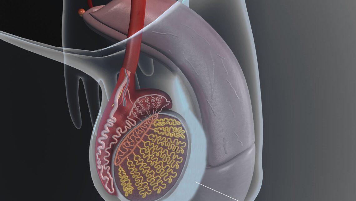 Hydrocele testiculaire 1