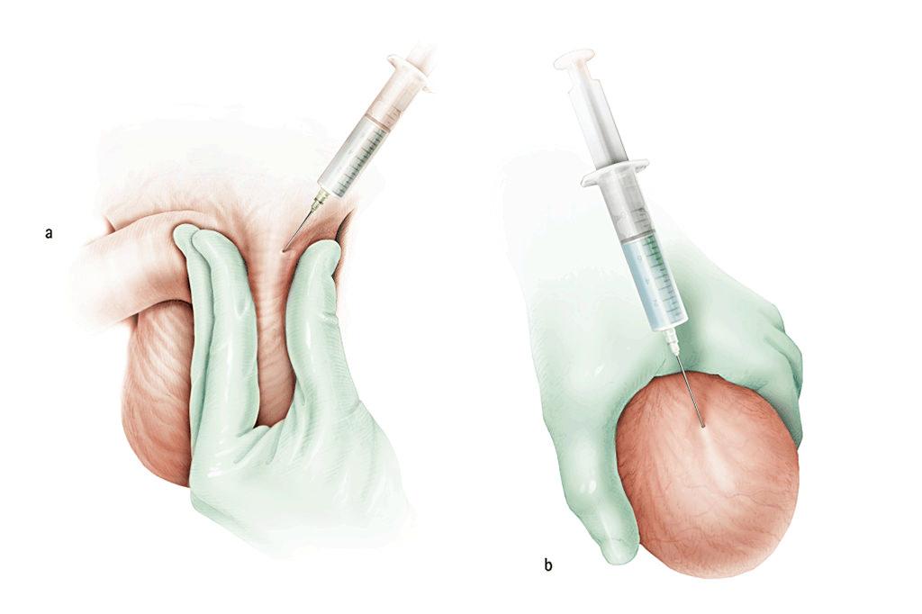 Hydrocele testiculaire drainage