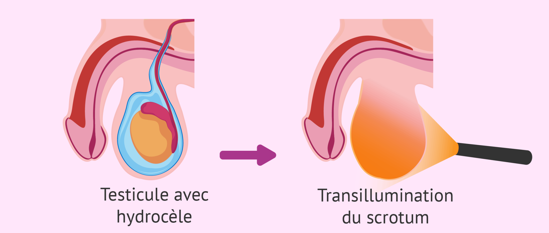 Hydrocele testiculaire transillumination du scrotum