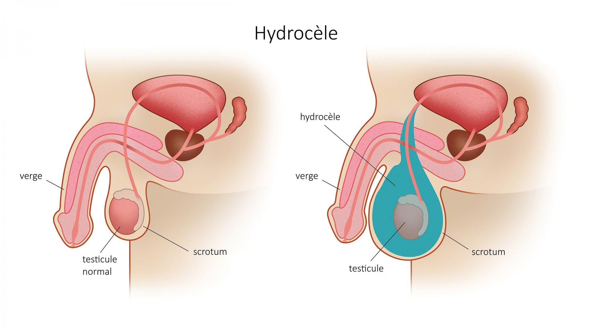 Hydrocele testiculaire