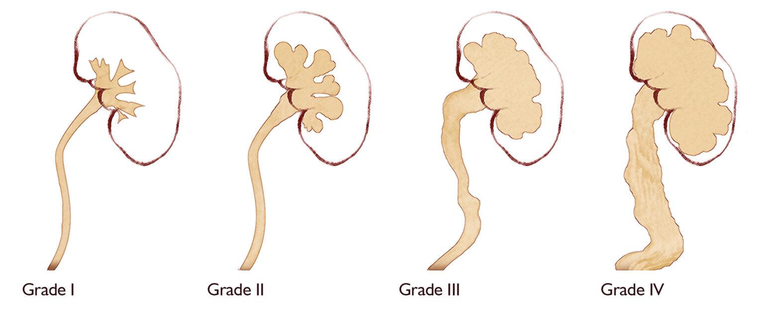 Hydronephrosis 1 1536x622 1