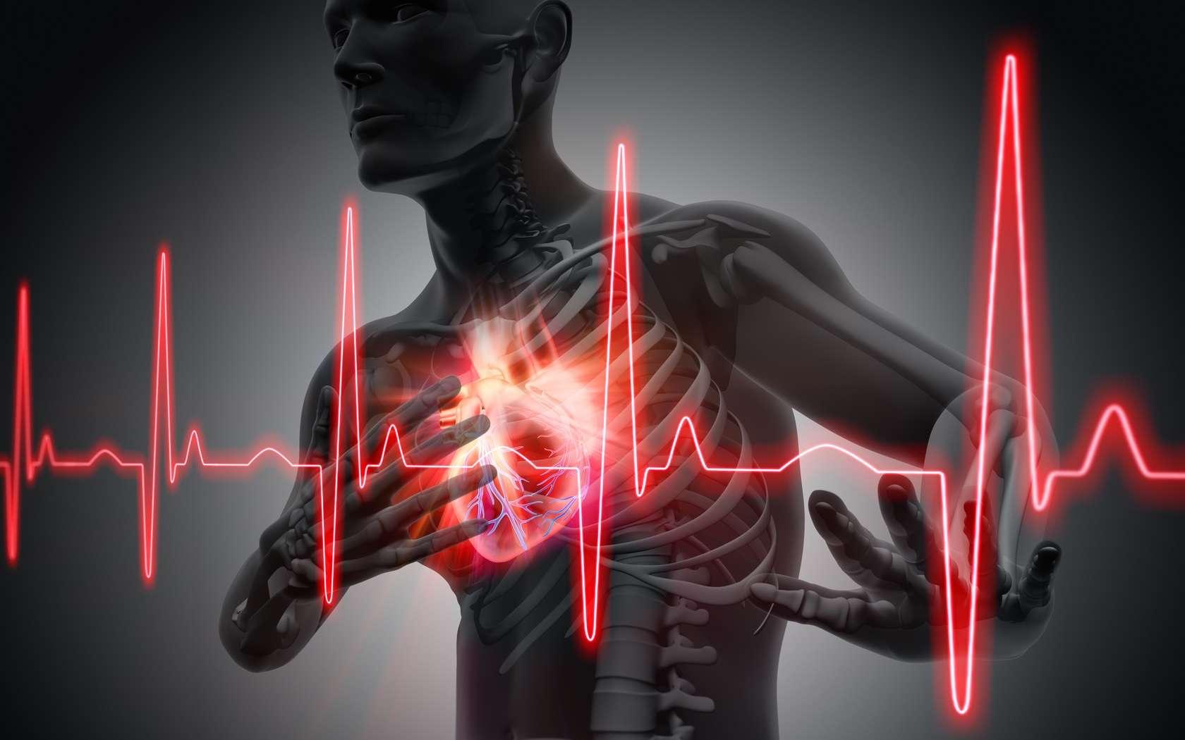 Infarctus du myocarde 