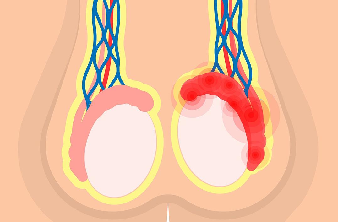 Kystes de l epididyme